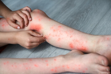 atopic dermatitis on the legs of a child