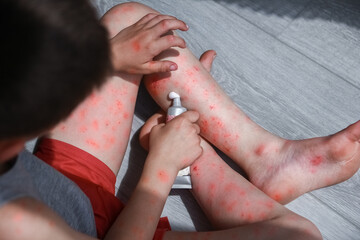 atopic dermatitis on the legs of a child