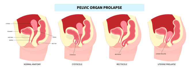 Pelvic organ prolapse with vagina sagging and the strengthening ligament therapy for menopause woman anatomy  - obrazy, fototapety, plakaty