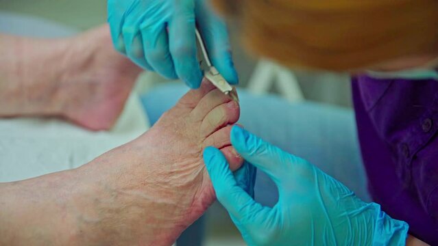 Cutting the keratinized skin of the feet with pliers.