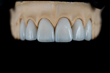 carillas dentales sobre molde, dientes cerámica 