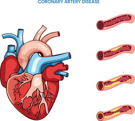 In Coronary artery disease heart arteries become narrow which reduced blood flow