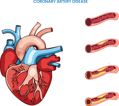 In Coronary artery disease heart arteries become narrow which reduced blood flow