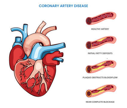In Coronary artery disease heart arteries become narrow which reduced blood flow