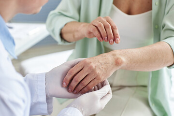Closeup of doctor inspecting skin rash on hand of female patient in dermatology clinic, copy space
