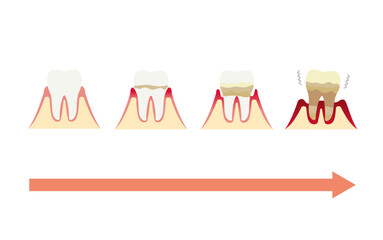 歯周病が進行する図解イラスト