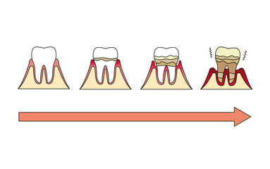 歯周病が進行する図解イラスト