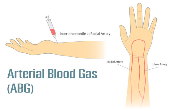 Arterial Blood Gas ABG test insert the needle at radial artery on wrist. Medical procedure vector isolated illustration on white background