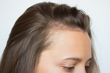 Cropped head shot of a young Caucasian woman with receding hairline on her forehead and temples....