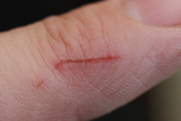 A finger wounded by a knife.