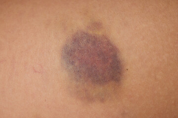 Accidents and wounds caused by impact. Purple skin bruises and abrasions.