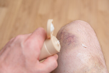 A man smears a huge bruise on a man's leg in the knee area with a THERAPEUTIC OINTMENT. Close-up of...