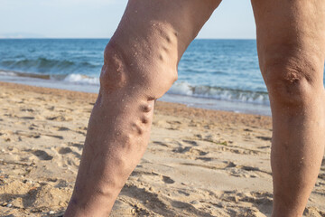 Female legs with varicose veins against the background of the sea. Spa treatment for sore legs - obrazy, fototapety, plakaty