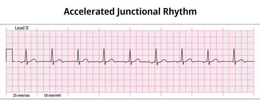 ECG Accelerated Junctional Rhythm - Escape Rhythm - 8 Second ECG Paper - Electrocardiogram Vector Medical Illustration