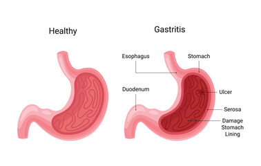Normal human stomach compared with gastritis