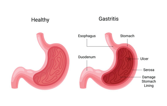 Dyspepsia Images – Browse 50,004 Stock Photos, Vectors, and Video | Adobe  Stock
