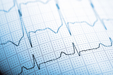 Close-up of an electrocardiogram printed on blue paper.