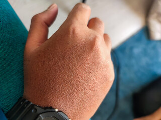 Close-up view of The skin on a man's hands is dry and cracked due to the cold effects of winter...