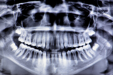 A panoramic radiograph of a girl fracture of the jawbone after a direct trauma to the left side, a...