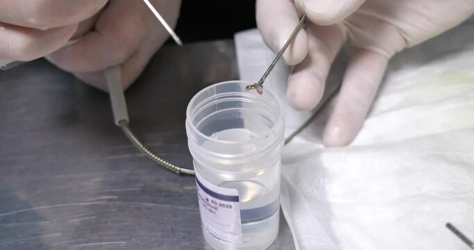 The doctor places the tissue sample taken during the endoscopic biopsy into a container of formaldehyde. Selection of material for histological examination. Concept of tissue for histolgia.