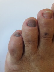 Unha do pé de pessoa com hipotireoidismo calosidades, micose, pele seca e desidratada