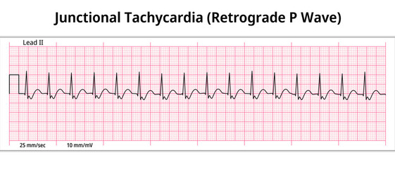 ECG Junctional Tachycardia - Retrograde P Wave - 8 Second ECG Paper - Electrocardiogram Vector Medical Illustration - obrazy, fototapety, plakaty
