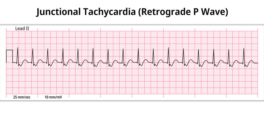 ECG Junctional Tachycardia - Retrograde P Wave - 8 Second ECG Paper - Electrocardiogram Vector Medical Illustration