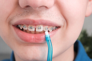 Teenager young man, European, close-up of braces on his teeth. Holds a toothbrush. Concept special dental alignment and jaw hygiene.