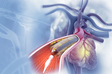 Balloon angioplasty procedure with stent in vein.3d illustration - obrazy, fototapety, plakaty