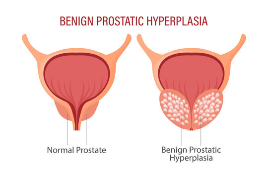 Benign prostatic hyperplasia. Anatomy of human organs. Medicine, healthcare and science concept. Education infographics banner