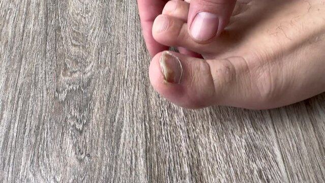 Nail fungus or psoriasis on the nail of the big toe