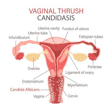 Vaginal fungal infection. Candidiasis. Infographics of gynecological diseases. Gynecology. Medicine. Infographic banner, vector.