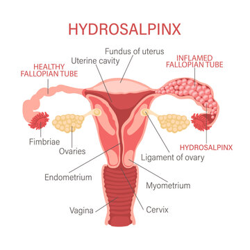 Hydrosalpinx. The fallopian tubes are blocked and filled with serous or clear fluid. Gynecology. Medicine. Infographics banner, vector.