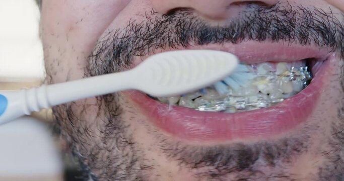 Cleaning metal braces with a toothbrush in longitudinal movements, shot close-up