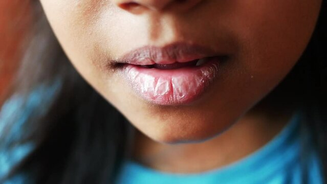 close up of dry lip of a child 