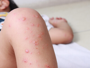 virus hfmd leg knee child asian allergic blister chicken pox dermatology measles medical skin disease reaction red stickers