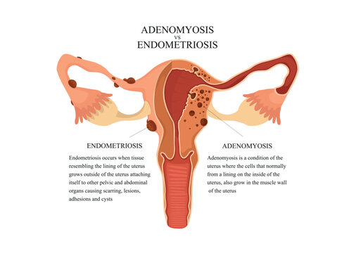 Adenomyosis vs endometriosis. Anatomical illustration of the female reproductive system with symptoms of adenomyosis, with annotations.