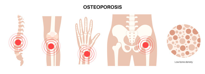 Osteoporosis medical poster - obrazy, fototapety, plakaty
