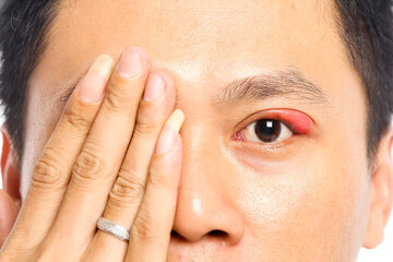 Portrait closeup of young Asian man with brown eyes with stye infection. eyelid abscess. eyelid infection. - obrazy, fototapety, plakaty