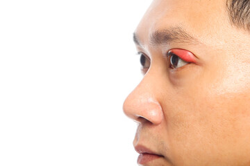 Portrait closeup of young Asian man with brown eyes with stye infection. eyelid abscess. eyelid...