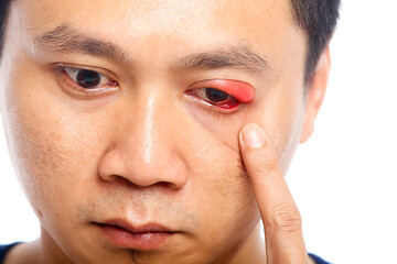 Portrait closeup of young Asian man with brown eyes with stye infection. eyelid abscess. eyelid...