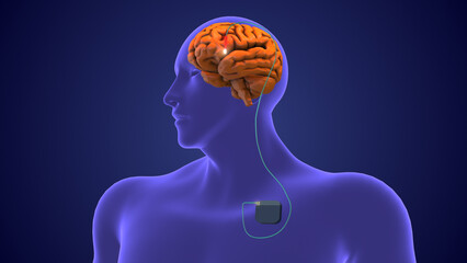 Deep brain stimulation medical concept	
 - obrazy, fototapety, plakaty