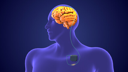 Deep brain stimulation medical concept	
 - obrazy, fototapety, plakaty