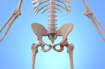 Skeleton with osteoarthritis hip joint injury - obrazy, fototapety, plakaty