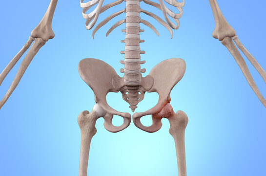 Skeleton with osteoarthritis hip joint injury