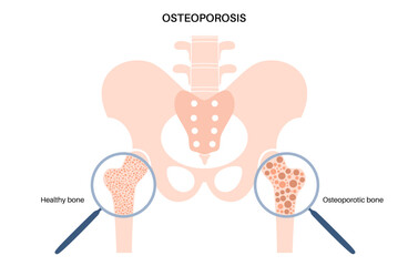 Osteoporosis medical poster - obrazy, fototapety, plakaty