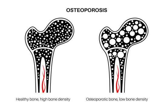 Osteoporosis medical poster