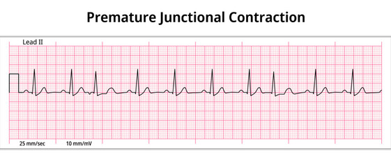 ECG Premature Junctional Contraction - 8 Second ECG Paper - Electrocardiogram Vector Medical Illustration