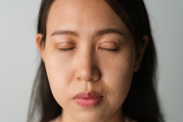 Asian woman with ongoing upper blepharoplasty surgery concept. Medical double eyelid plastic surgery, front view face closing eyes showing stitches and bruises on the eyelids. On white background.