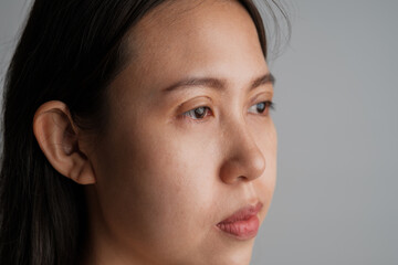 Asian woman with ongoing upper blepharoplasty surgery concept. Medical double eyelid plastic surgery, left side view face showing bruises on the eyelids. On white background blank copyspace.